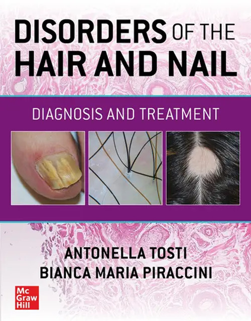 Disorders of the hair and nail: diagnosis and treatment