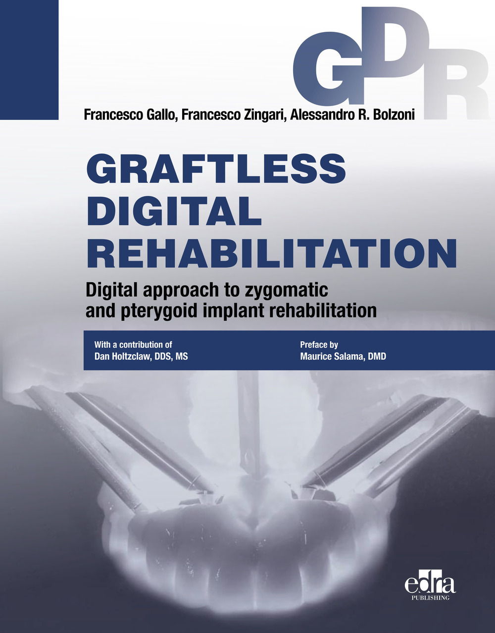 Graftless digital rehabilitation, gdr. Digital approach to zygomatic and pterygoid implant rehabilitation