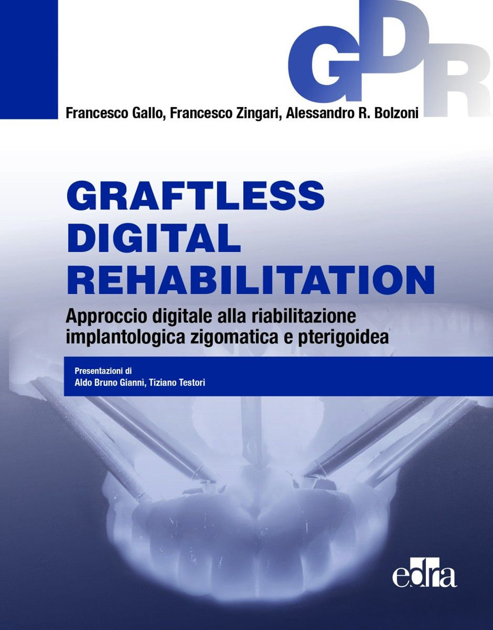 Graftless digital rehabilitatio, GDR. Approccio digitale alla riabilitazione implantologica zigomatica e pterigoidea