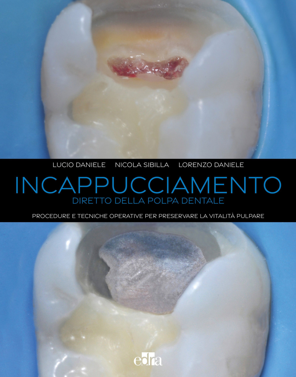 Incappucciamento diretto della polpa dentale. Procedure e tecniche operative per preservare la vitalità pulpare