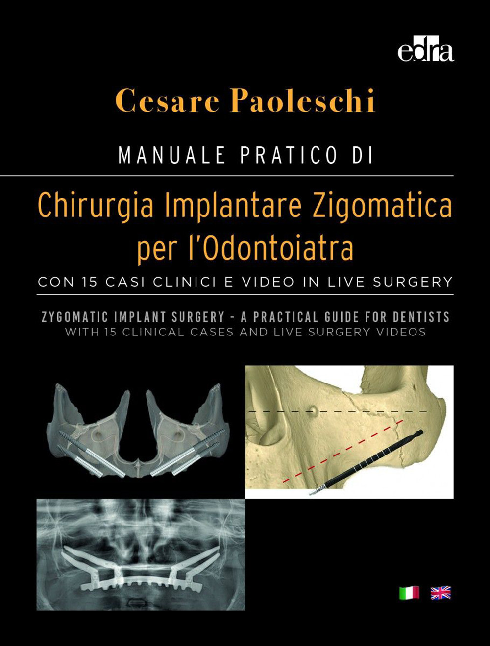 Manuale pratico di chirurgia implantare zigomatica per l’odontoiatra. Con 15 casi clinici e video in live surgery-Zygomatic implant surgery. A practical guide for dentist. With 15 clinical cases and live surgery videos