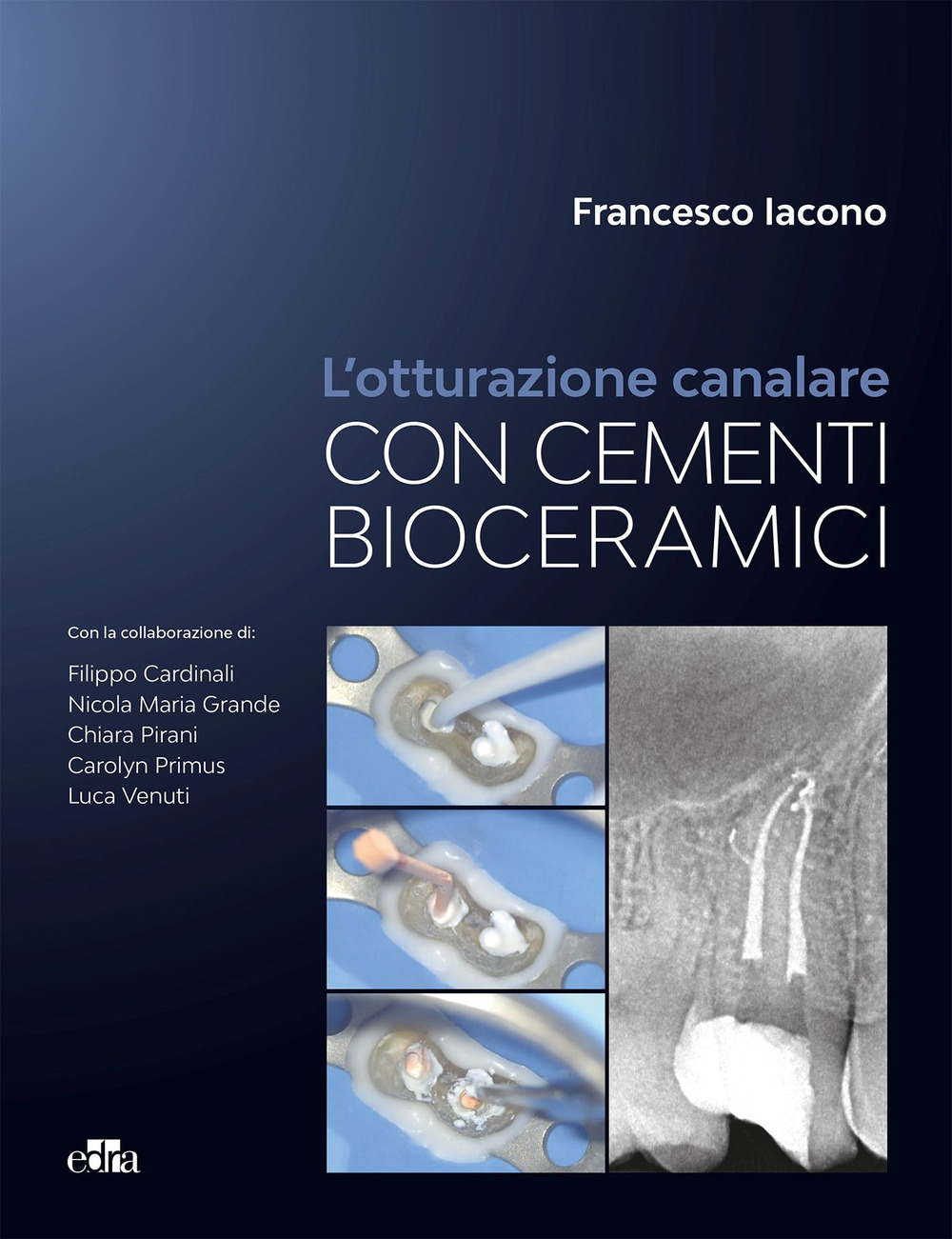L'otturazione canalare con cementi bioceramici