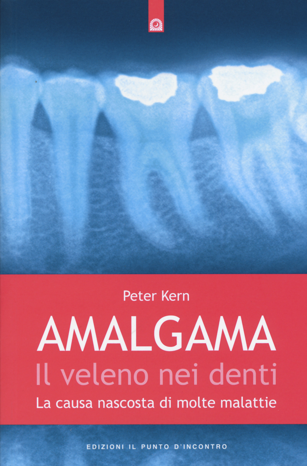 Amalgama. Il veleno nei denti. La causa nascosta di molte malattie