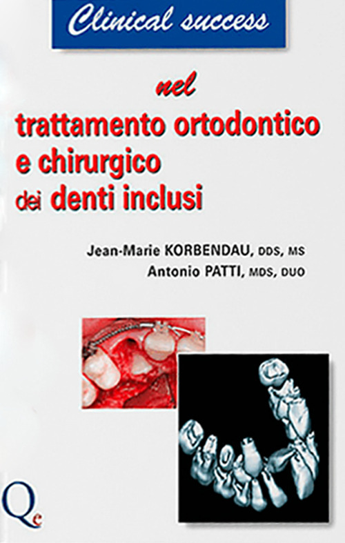 Trattamento ortodontico e chirurgico dei denti inclusi