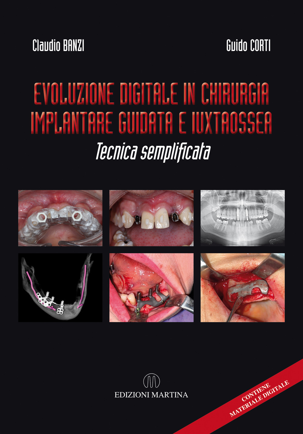 Evoluzione digitale in chirurgia implantare guidata e iuxtaossea. Tecnica semplificata. Ediz. italiana e inglese