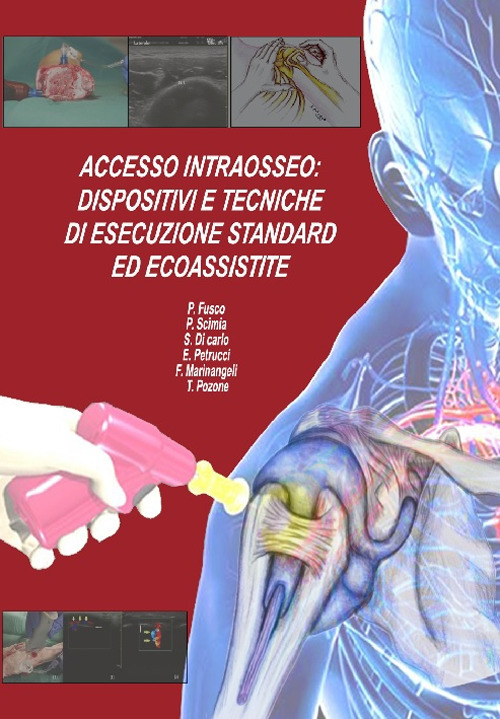 Accesso intraosseo. Dispositivi e tecniche di esecuzione standard ed ecoassistite