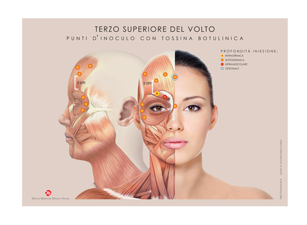 Terzo inferiore e terzo superiore del volto. Punti d'inoculo con tossina botulinica. Tavole