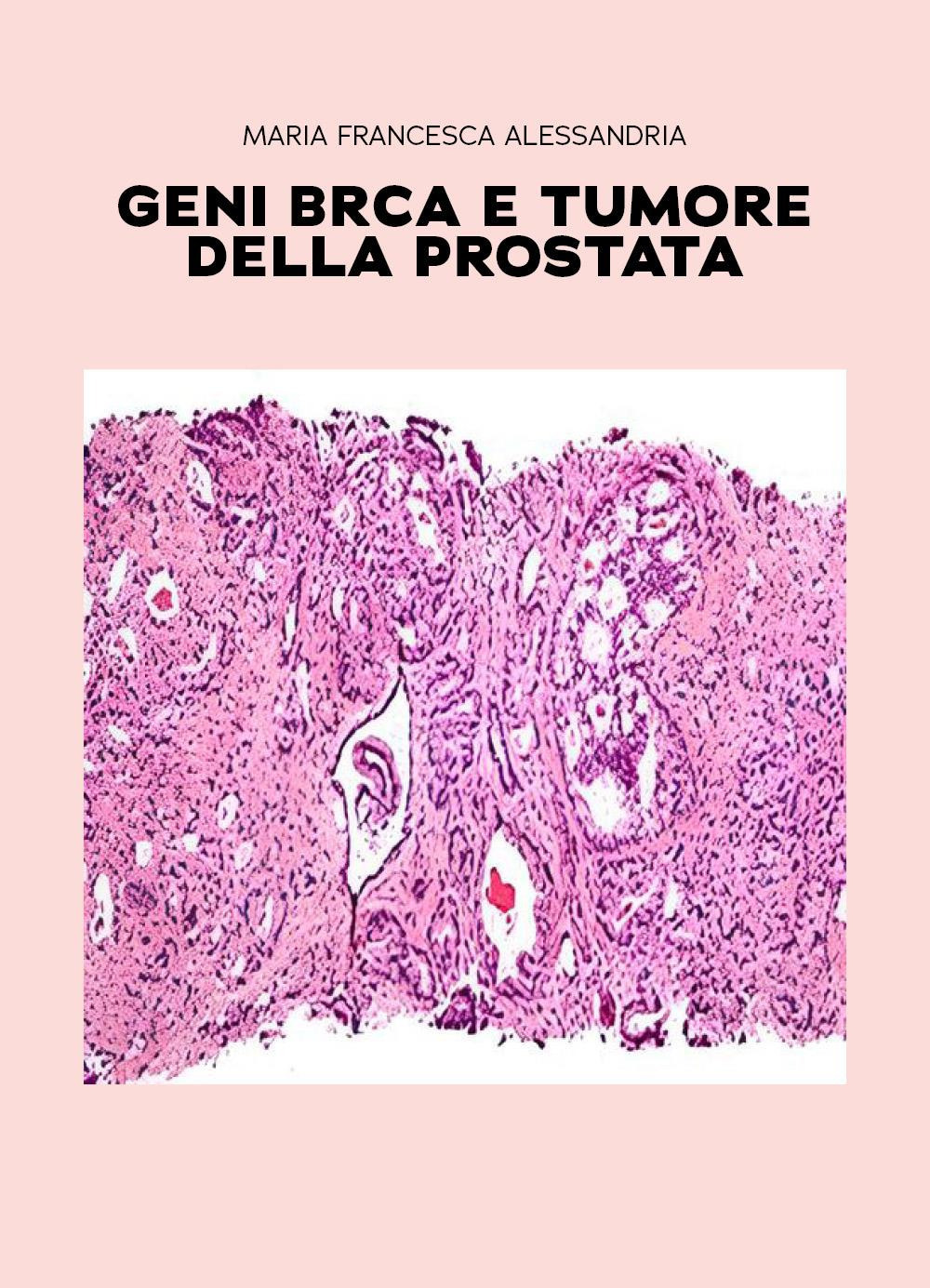 Geni BRCA e tumore della prostata