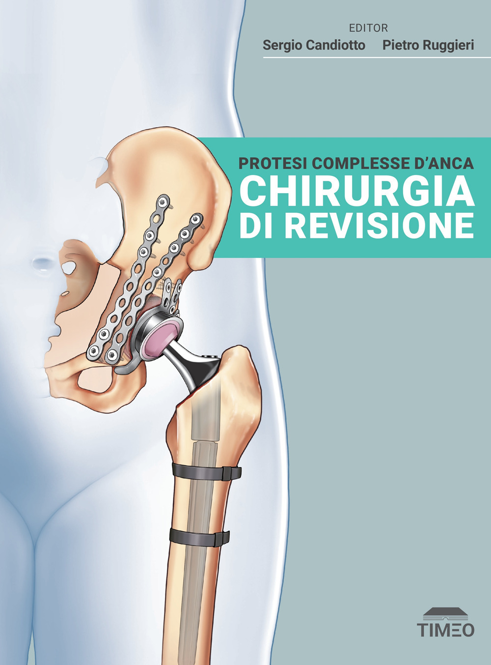 Protesi complesse d'anca. Chirurgia di revisione